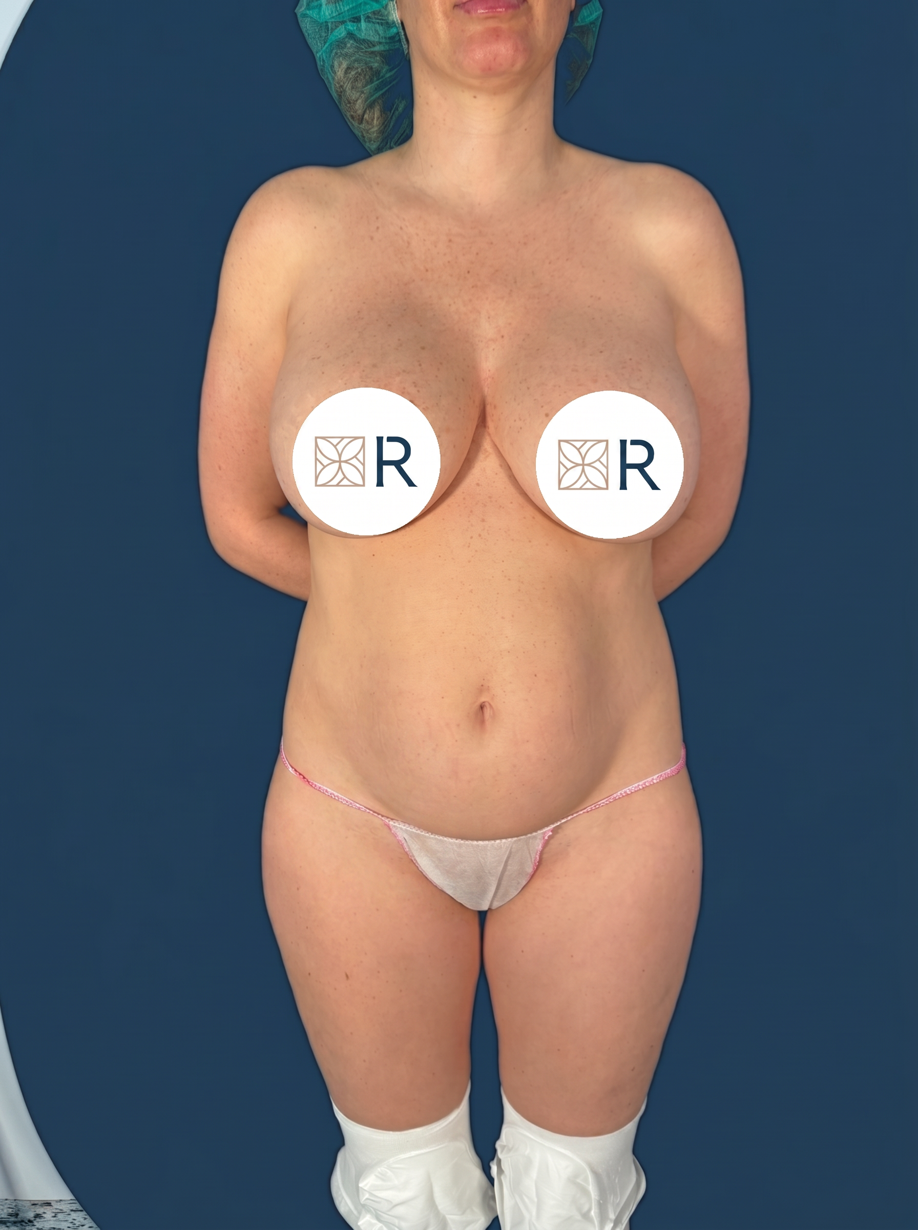 Mommy Makeover Instituto Rubí - Caso 10 antes de la cirugía