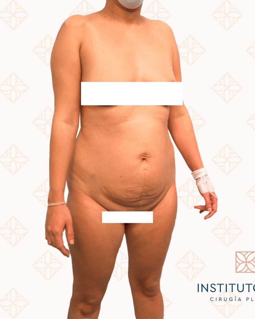Mommy Makeover Instituto Rubí - Caso 7 antes de la cirugía
