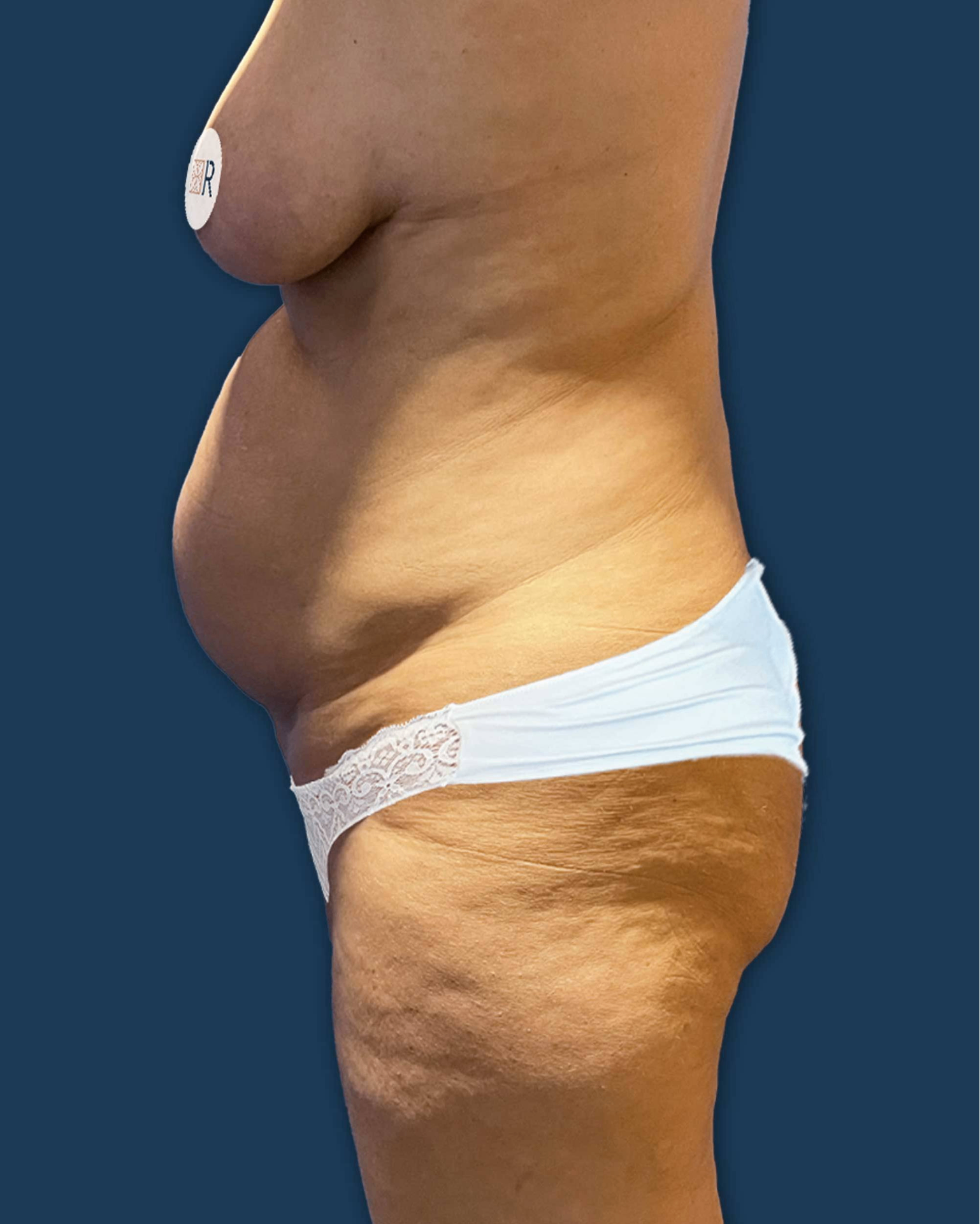Mommy Makeover Instituto Rubí - Caso 6 antes de la cirugía