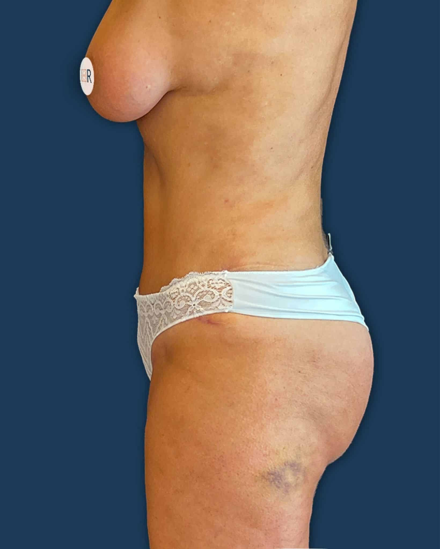 Mommy Makeover Instituto Rubí - Caso 6 después de la cirugía