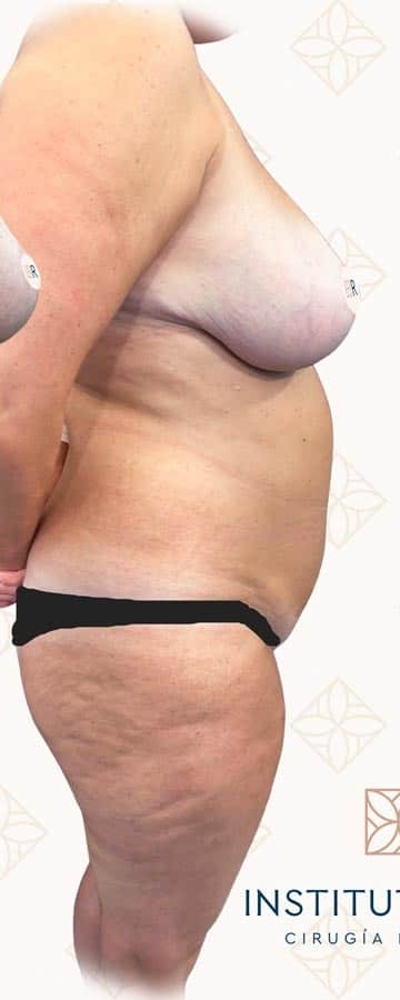 Mommy Makeover Instituto Rubí - Caso 4 antes de la cirugía