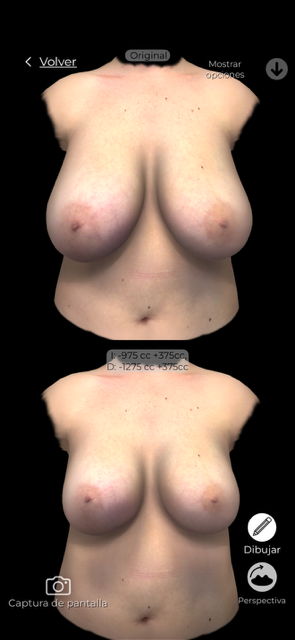 Simulación 3D de aumento mamario — Aumento con elevación · Caso real · Instituto Rubí.