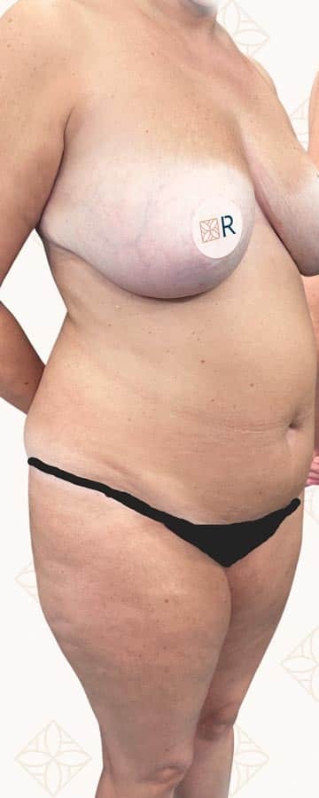 Mommy Makeover Instituto Rubí - Caso 3 antes de la cirugía